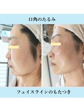 ノト(NOTO)/たるみ・もたつき