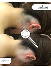 クラリティー 阿佐ヶ谷店(CLARITY)/うなじ脱毛　サイド