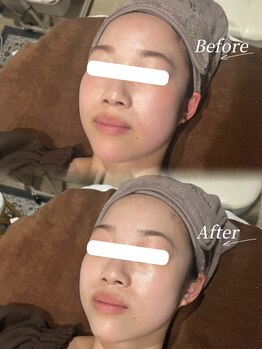 ソア(Soa)/美白マグネットパック×毛穴洗浄