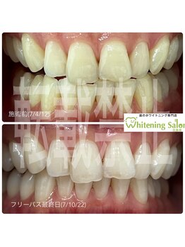 ホワイトニングサロン 広島店/【ホワイトニング施術例】
