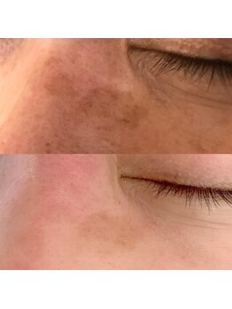 エメ(Aimer)/【60代老人性シミ結果写真☆】