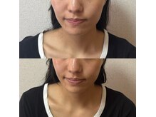 ルピナス 立川店/小顔矯正