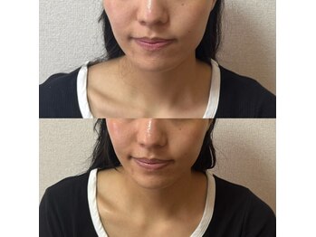 ルピナス 立川店/小顔矯正