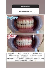 エクシアホワイトニング 徳島店/ホワイトニングストーリー10
