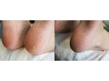 エクリュ(ecru)/フットパドル角質ケア