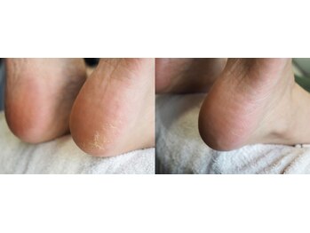 エクリュ(ecru)/フットパドル角質ケア