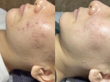 エモーショナル 姫路(Emotional)/ハーブピーリングで肌質改善