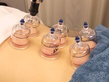 トータルケア鍼灸院/吸い玉