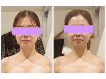 エステティックサロン アンジュ(Ange)/ブライダルエステにもコルギ