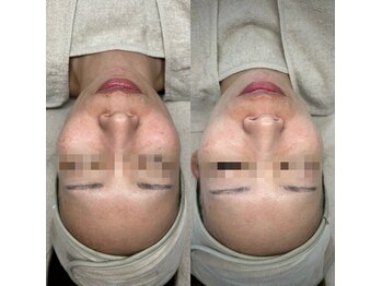 ルアンビューティー メディカルプラス(Luan beauty MEDICAL+)/ララピール×LDM×1回