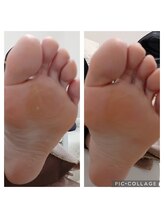 遊歩堂/ヒールダコ