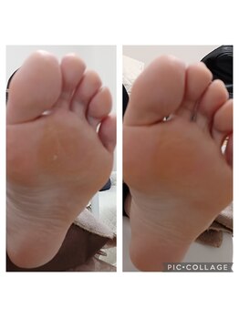 遊歩堂/ヒールダコ