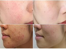 ナチュレアンドメディカ(Nature&Medica)/顔脱毛＋肌荒れケアフェイシャル