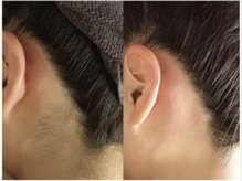 オーシャンブルー 佐世保店(OCEAN BLUE)/結果が出る脱毛【うなじ】