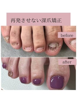 ティアラネイル(tiaranail)/再発させない深爪矯正