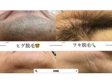 ワン(ONE)の雰囲気（6年連続殿堂入り脱毛器）