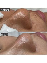 ライカブルー(RaicA BluE)/施術写真　before-after