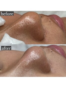 ライカブルー(RaicA BluE)/施術写真　before-after