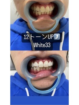 アイブロウ33 久留米店/【ホワイトニングBefore After】