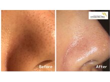 リラクゼーションルームトフレ(relaxation room toefre)/毛穴洗浄フェイシャル2