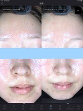 ウニ(uni)/オーダーメイド肌管理の症例です