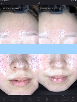 ウニ(uni)/オーダーメイド肌管理の症例です