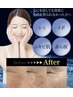 【ニキビケア/毛穴/改善】ニキビケア＋ヒト幹細胞導入を加え更に滑らか効果UP