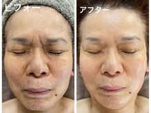 ナオフクオカ ヒーリングフォースエヌ(NaoFukuoka/healingforceN)/74歳オールハンドでたるみ知らず