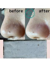 メイト(mate)/毛穴エクストラクションtete式