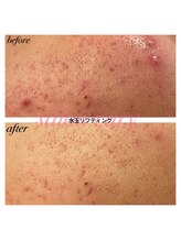 サロンヴェアリー 広尾(salon vary)/水玉リフティング　#ニキビケア