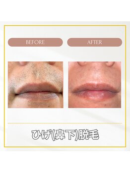 エクレ(EKURE)/男性ヒゲ脱毛