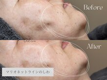 アイシス(AIsis)/【LDM/60代】シワ改善