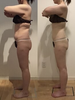 エステティックサロン フェアリー(ESTHETIC SALON FAIRLY)/痩身＊セルゼロBefore→After