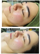 ナチュラルビューティラテ(NATURAL BEAUTY LATTE)/レチノールモニター