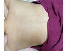 エステサロン ジジ 新宿(JIJI)/プラズマ背中ケアのお客様