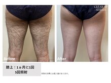 ザ エッセンシャル 碧南(THE Essential)/メンズ　脚脱毛