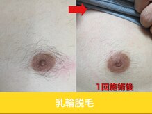 ミスターアンクール 鹿児島(Mr.uncoeur)/乳輪脱毛1回後から2ヶ月経過