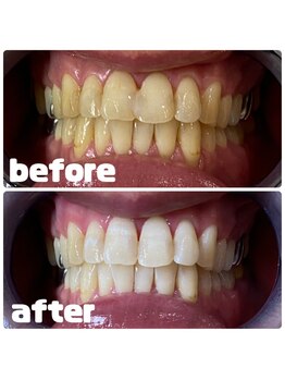 ホワイトベリー 空港通店(White Berry)/ホワイトニング:ビフォアフター