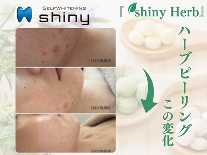 ホワイトニングサロン シャイニー 浜松細島店(shiny)の写真