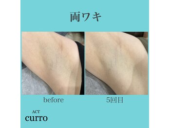 アクト クロ(ACT curro)/【両ワキ】脱毛施術例