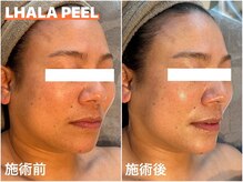 タオ(TAO)/施術写真：ララピール