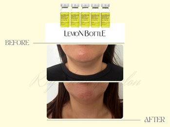 リー(Riy)/《Before and After》