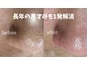 人気No.1【黒ずみ角栓除去】いちご鼻・黒ずみ1発解消！￥10,000→初回￥6,000