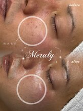 メルリー(Meruly)/サーマトリックス×幹細胞導入