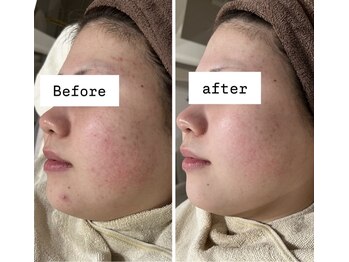 アリス(ALICE)/毛孔性苔癬にもハーブピーリング