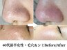 【毛穴ケア&シミケア】黒ずみ/角栓・シミくすみ｜すっぴんで自信◎24800円⇒