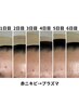 【赤ニキビ・肌荒れ】ハイドラ洗浄×プラズマ　20800→6600円