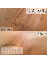 エステティックサロンR/圧倒的効果◎最短美肌脱毛♪