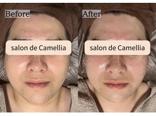 サロンドカメリア(salon de Camellia)/お顔の脂肪におさらば！