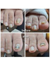 爪切り屋 足楽/巻いた爪のリフトアップ